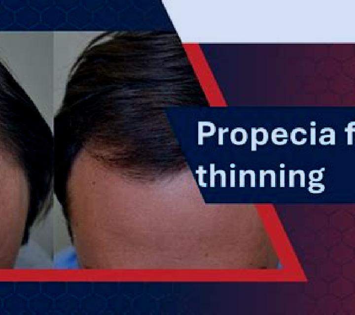Propecia propecia thinning skn pharmacy