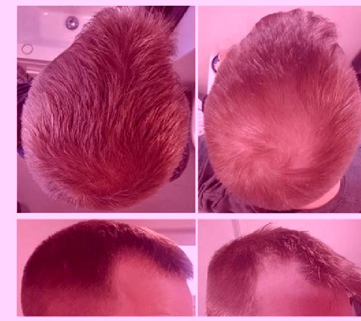 Propecia shaving your head before taking propecia medication