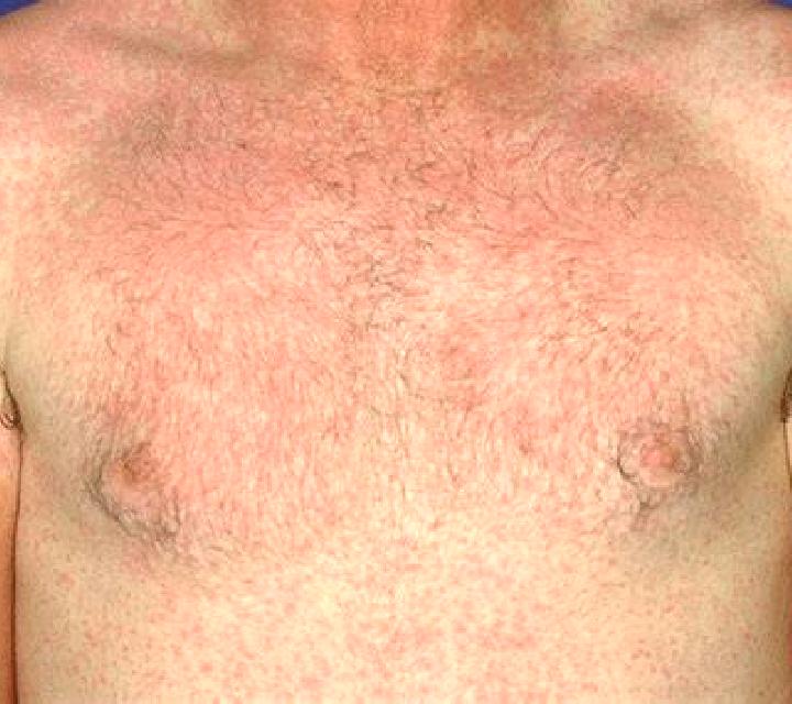 Provigil provigil side effects rash medication