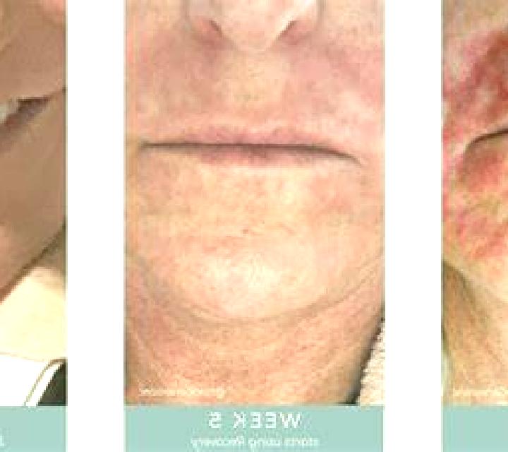 Tretinoin 0,05 medication